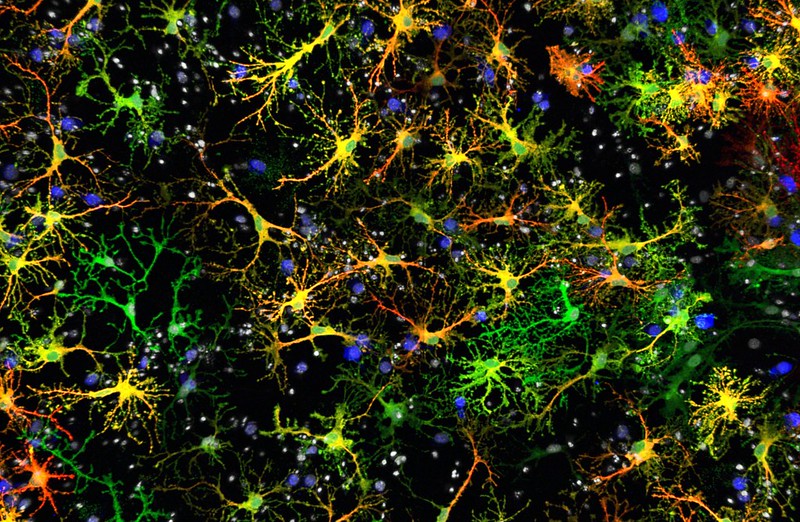alzheimer's brain